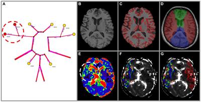 Personalised simulation of hemodynamics in cerebrovascular disease: lessons learned from a study of diagnostic accuracy